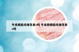 牛皮癬能吃維生素c嗎 牛皮膚癬能吃維生素c嗎