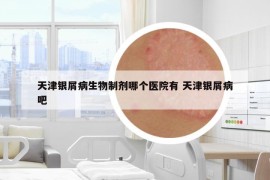 天津銀屑病生物制劑哪個醫(yī)院有 天津銀屑病吧