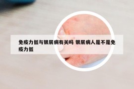 免疫力低與銀屑病有關(guān)嗎 銀屑病人是不是免疫力低