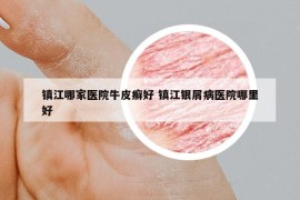 鎮(zhèn)江哪家醫(yī)院牛皮癬好 鎮(zhèn)江銀屑病醫(yī)院哪里好