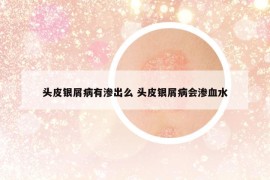 頭皮銀屑病有滲出么 頭皮銀屑病會(huì)滲血水