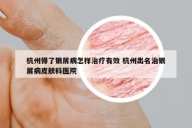 杭州得了銀屑病怎樣治療有效 杭州出名治銀屑病皮膚科醫(yī)院