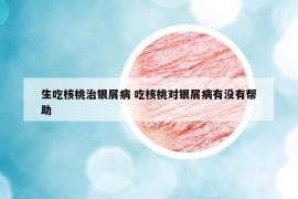 生吃核桃治銀屑病 吃核桃對(duì)銀屑病有沒有幫助
