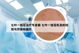 七葉一枝花治療牛皮癬 七葉一枝花乳膏的功效與作用和圖片