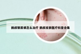 鶴叔銀屑病怎么治療 鶴叔皮膚醫(yī)療科普合集