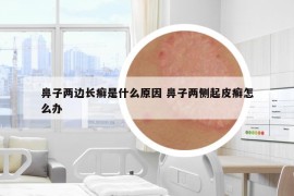 鼻子兩邊長癬是什么原因 鼻子兩側(cè)起皮癬怎么辦