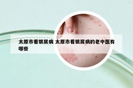 太原市看銀屑病 太原市看銀屑病的老中醫(yī)有哪些