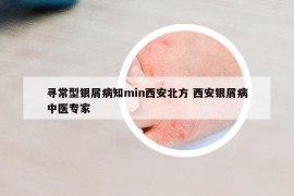 尋常型銀屑病知min西安北方 西安銀屑病中醫(yī)專家