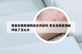 男朋友銀屑病同床會(huì)傳染嗎 男友有銀屑病被傳染了怎么辦