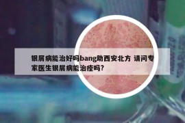 銀屑病能治好嗎bang助西安北方 請(qǐng)問專家醫(yī)生銀屑病能治痊嗎?