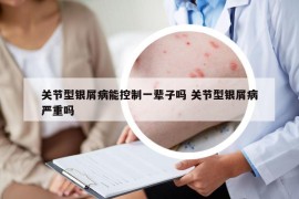 關(guān)節(jié)型銀屑病能控制一輩子嗎 關(guān)節(jié)型銀屑病嚴(yán)重嗎