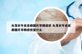 頭發(fā)長牛皮皮癬圖片早期癥狀 頭發(fā)長牛皮皮癬圖片早期癥狀是什么