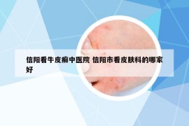 信陽看牛皮癬中醫(yī)院 信陽市看皮膚科的哪家好