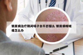 銀屑病治療期間嗓子會(huì)不舒服么 銀屑病喉嚨痛怎么辦