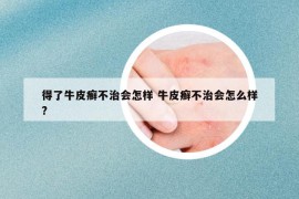 得了牛皮癬不治會(huì)怎樣 牛皮癬不治會(huì)怎么樣?