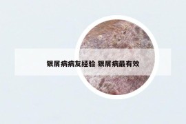 銀屑病病友經(jīng)驗 銀屑病最有效