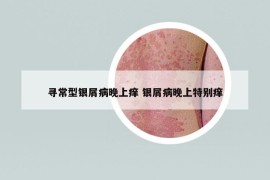 尋常型銀屑病晚上癢 銀屑病晚上特別癢