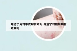 唯達寧片對牛皮癬有效嗎 唯達寧對銀屑病有效果嗎