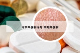 河南牛皮癬治療 南陽牛皮癬