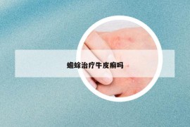 蟾蜍治療牛皮癬嗎