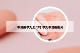 牛皮癬睪丸上長(zhǎng)嗎 睪丸牛皮癬圖片