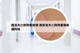 西交大二附院銀屑病 西安交大二附院看銀屑病咋樣