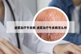 通菜治療牛皮癬 通菜治療牛皮癬怎么樣