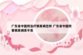 廣東省中醫(yī)院治療銀屑病怎樣 廣東省中醫(yī)院看銀屑病貴不貴