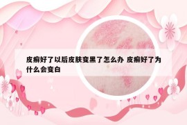 皮癬好了以后皮膚變黑了怎么辦 皮癬好了為什么會變白