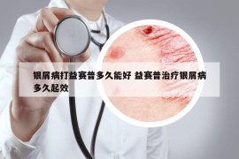 銀屑病打益賽普多久能好 益賽普治療銀屑病多久起效