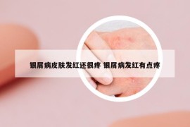 銀屑病皮膚發(fā)紅還很疼 銀屑病發(fā)紅有點(diǎn)疼