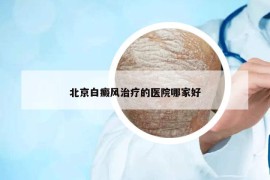 北京白癜風(fēng)治療的醫(yī)院哪家好