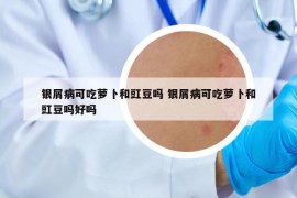 銀屑病可吃蘿卜和豇豆嗎 銀屑病可吃蘿卜和豇豆嗎好嗎