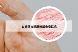 白癜風皮膚摩擦后會變紅嗎