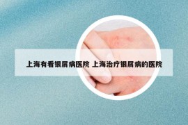 上海有看銀屑病醫(yī)院 上海治療銀屑病的醫(yī)院