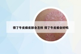 得了牛皮癬皮膚會(huì)怎樣 得了牛皮癬會(huì)好嗎
