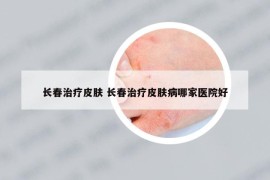 長春治療皮膚 長春治療皮膚病哪家醫(yī)院好