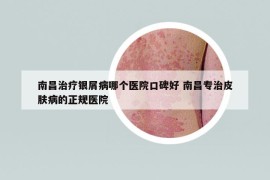 南昌治療銀屑病哪個醫(yī)院口碑好 南昌專治皮膚病的正規(guī)醫(yī)院
