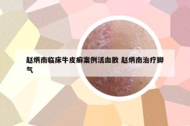 趙炳南臨床牛皮癬案例活血散 趙炳南治療腳氣