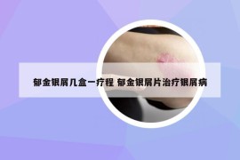 郁金銀屑幾盒一療程 郁金銀屑片治療銀屑病