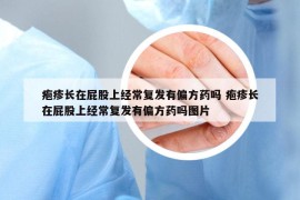 皰疹長在屁股上經(jīng)常復發(fā)有偏方藥嗎 皰疹長在屁股上經(jīng)常復發(fā)有偏方藥嗎圖片