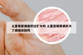 兒童銀屑病面積還擴(kuò)大嗎 兒童患銀屑病長(zhǎng)大了病情會(huì)輕嗎