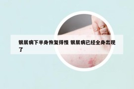 銀屑病下半身恢復(fù)得慢 銀屑病已經(jīng)全身出現(xiàn)了