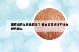 銀屑病男友把我趕走了 我有銀屑病該不該告訴男朋友