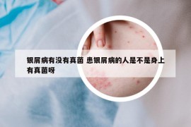 銀屑病有沒有真菌 患銀屑病的人是不是身上有真菌呀