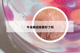 牛皮癬結(jié)痂算好了嗎