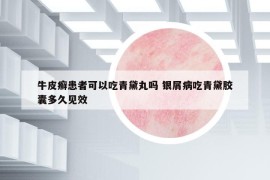 牛皮癬患者可以吃青黛丸嗎 銀屑病吃青黛膠囊多久見效