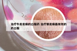 治療牛皮皮癬的口服藥 治療銀皮癬最有效的藥口服