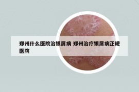 鄭州什么醫(yī)院治銀屑病 鄭州治療銀屑病正規(guī)醫(yī)院