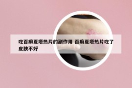 吃百癬夏塔熱片的副作用 百癬夏塔熱片吃了皮膚不好